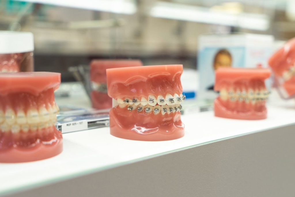 Braces in Spring, Texas braces in Spring, TX