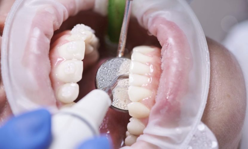 dental cleaning in spring tx dental cleaning in spring tx