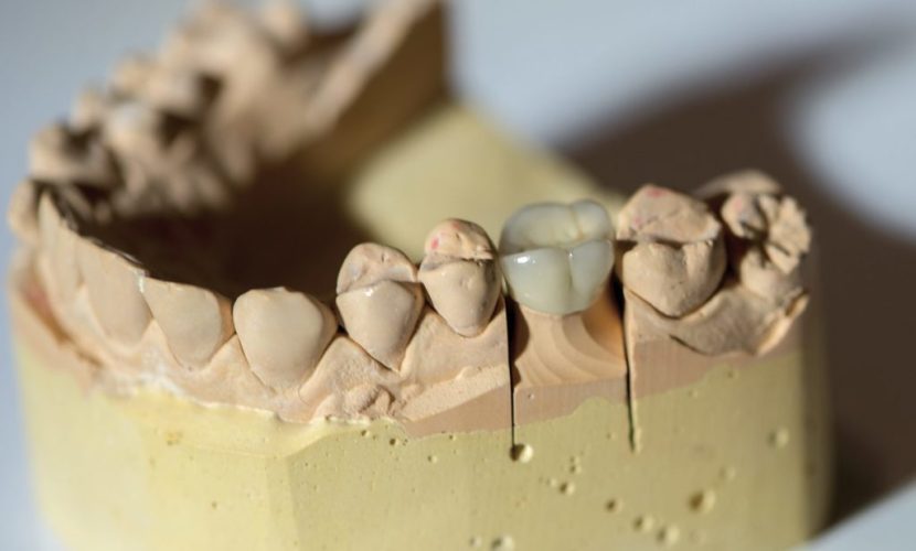 dental crowns in spring tx