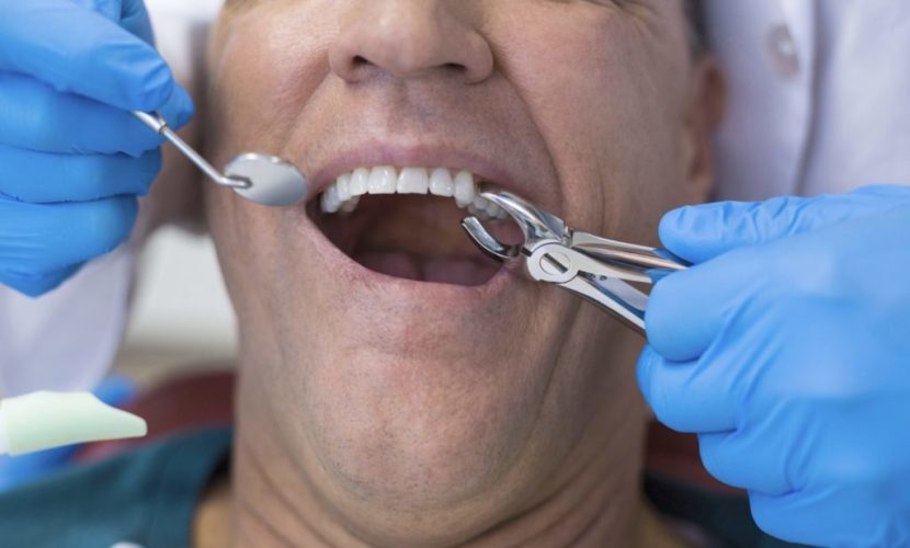 extractions Tooth extractions in Spring, Tx